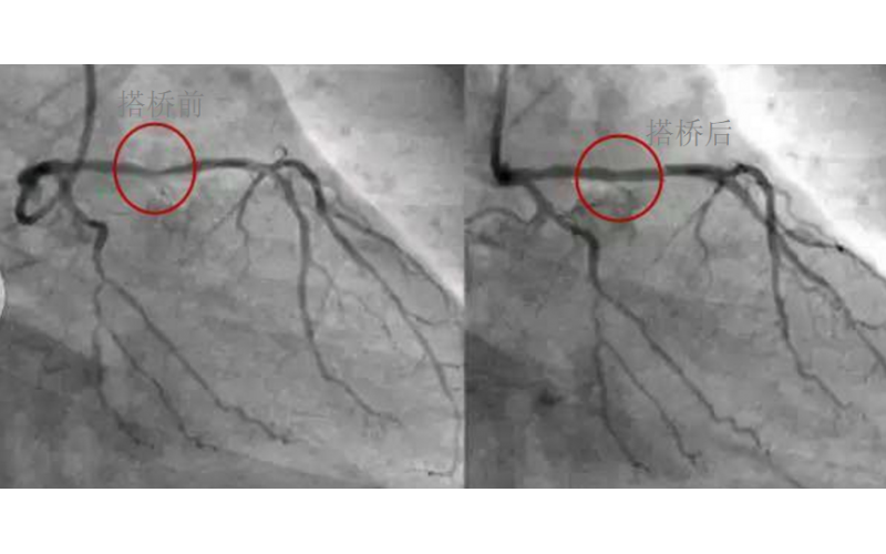 深圳市模具廠對心臟支架的關(guān)注，國產(chǎn)化的道路有多長？